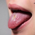 علائم اولیه سرطان زبان