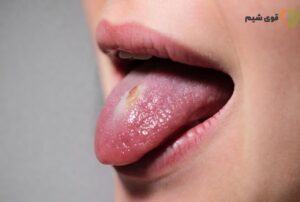 علائم اولیه سرطان زبان