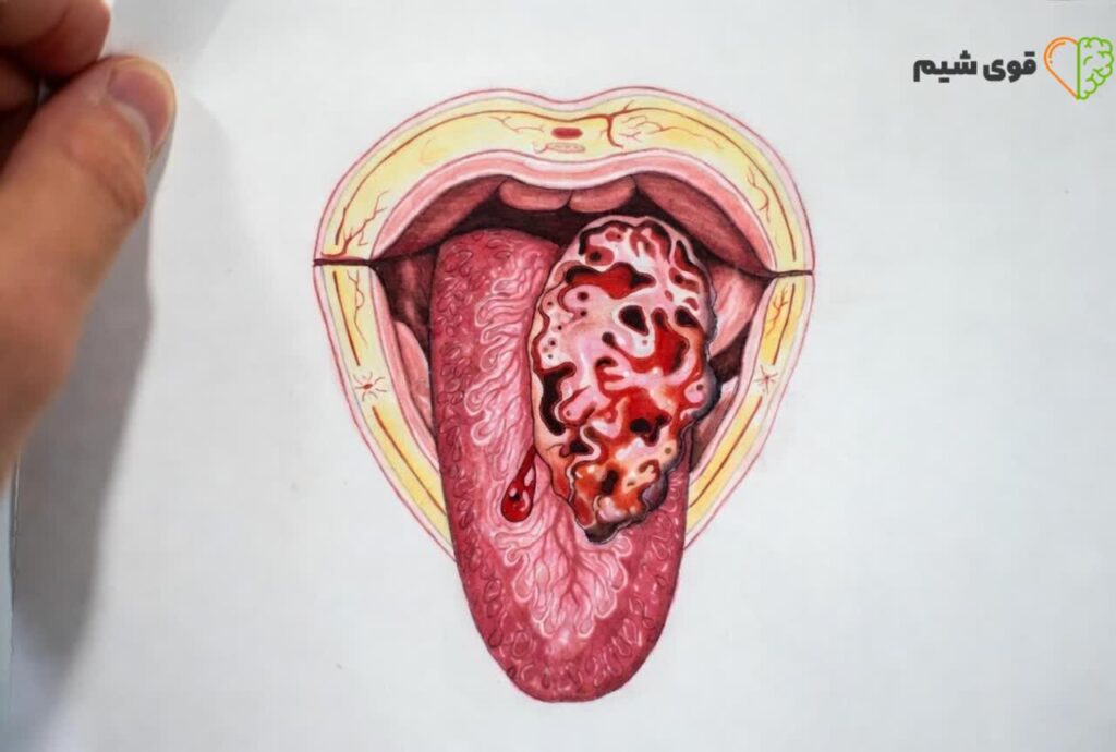 علامت سرطان زبان