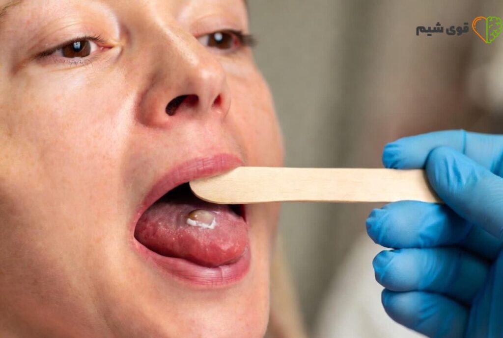 نشانه های اولیه سرطان زبان